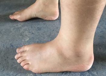 Wasser In Den Beinen: Ursachen Symptome Und Behandlung